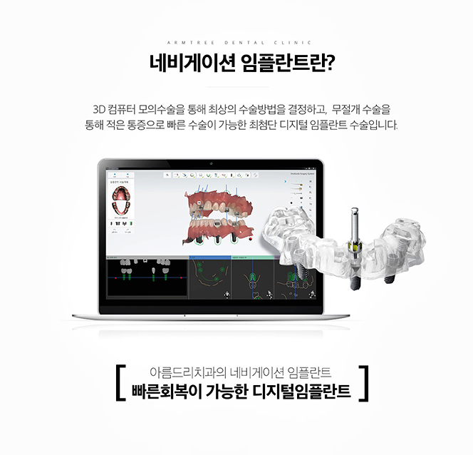 아름드리치과 임플란트의 안전성과 정확성을 높이다 관련 이미지 4
