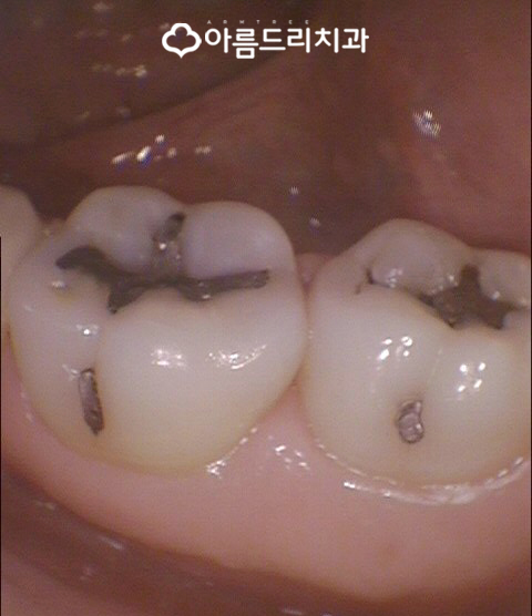 충치인레이 아말감주변 충치치료는? 관련 이미지 4