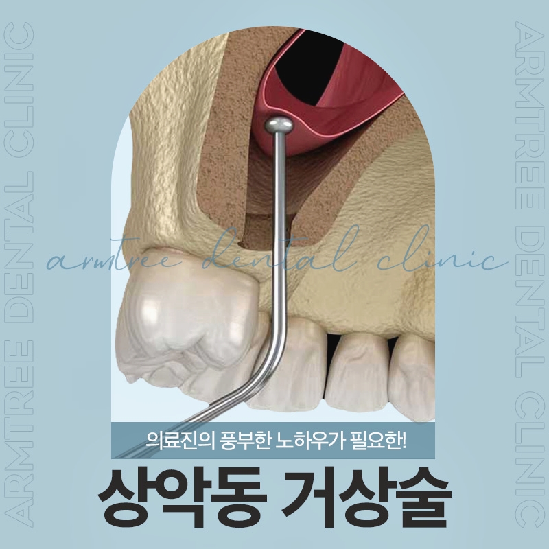 상악동거상술 고민은 신논현역 아름드리치과에서 관련 이미지 1