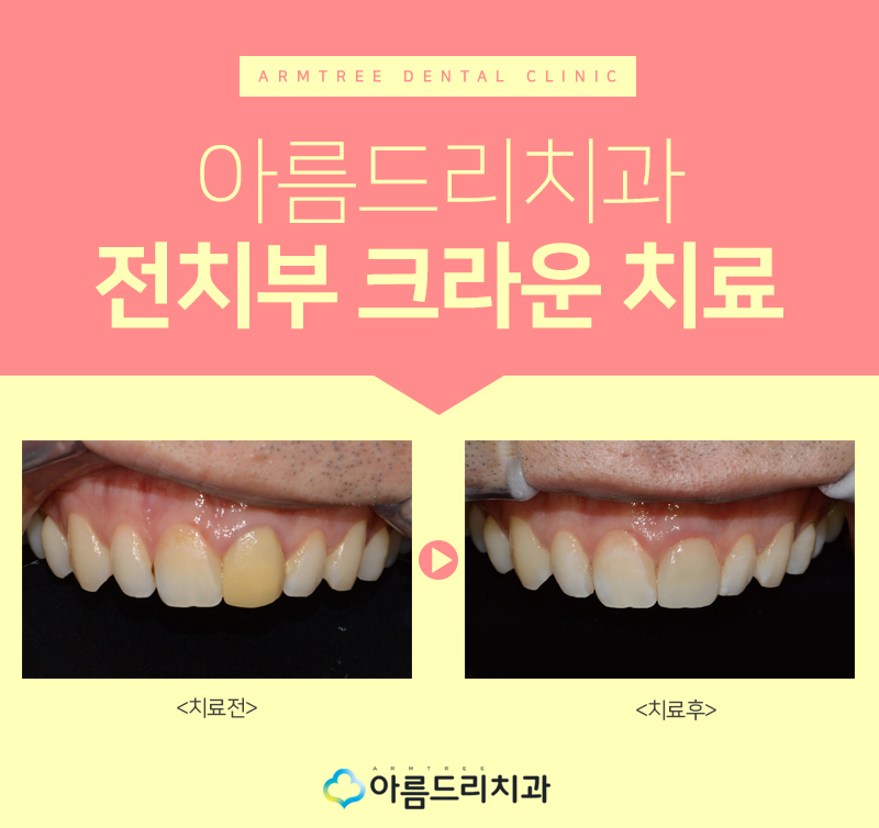 앞니 임시치아 전치부 크라운 재치료 관련 이미지 7