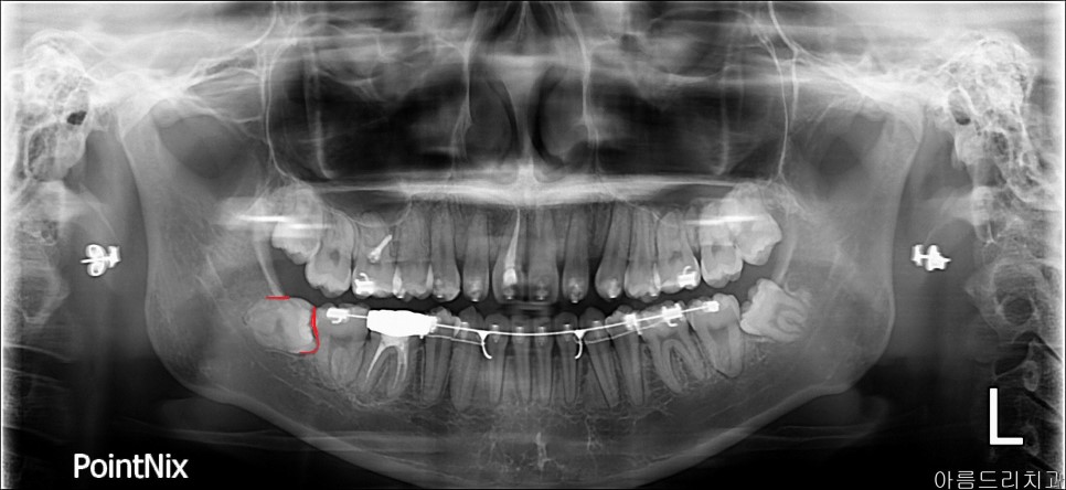 강남 아름드리치과 수술 발치_매복치 신논현치과 관련 이미지 3