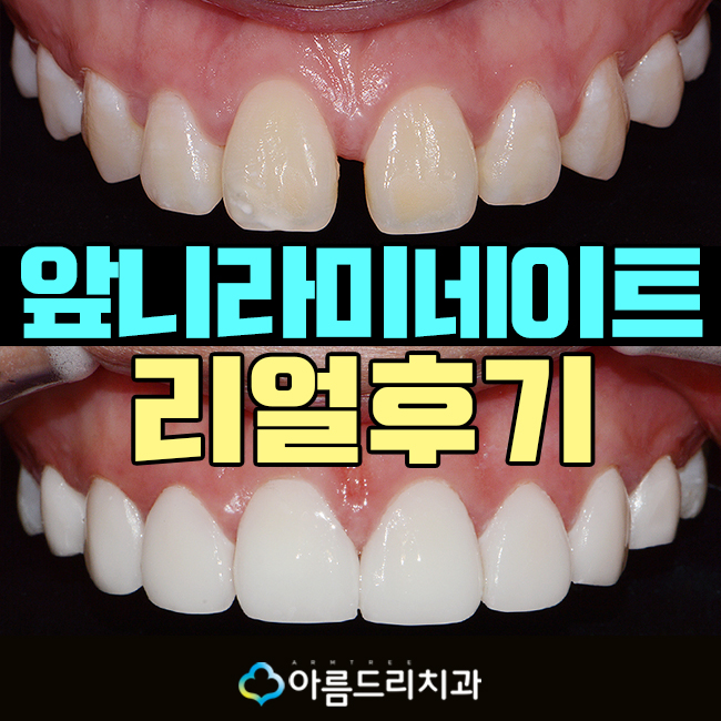 라미네이트부작용 걱정은노 관련 이미지 1