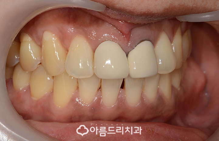 실활치미백 치은 잇몸퇴축 재생으로 동안치아 관련 이미지 4