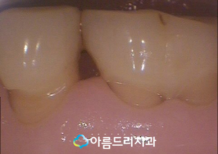 치경부마모증 잇몸파임 시린이 치료 관련 이미지 8