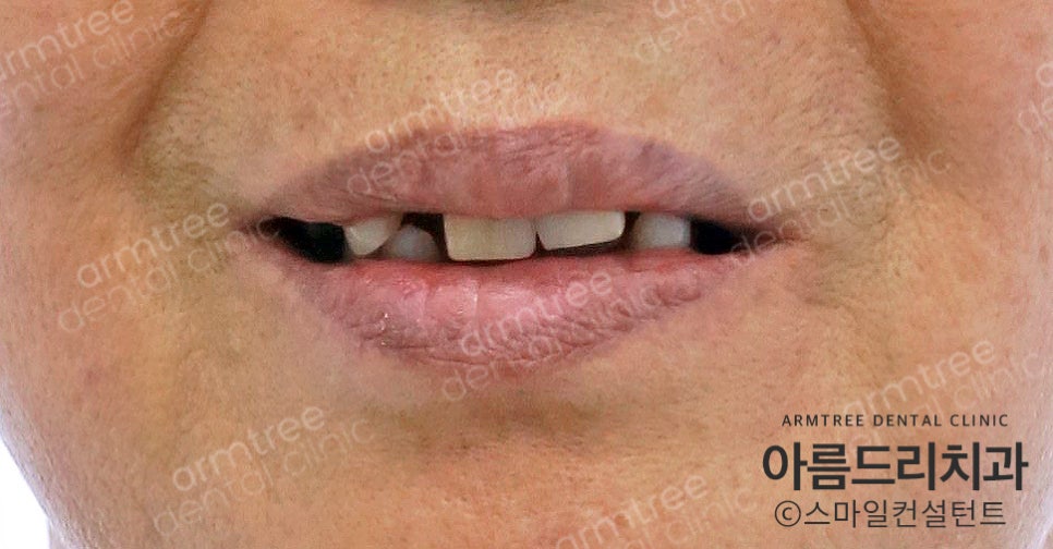 임플란트 심미보철 전후 아름드리치과 진료일기 관련 이미지 1