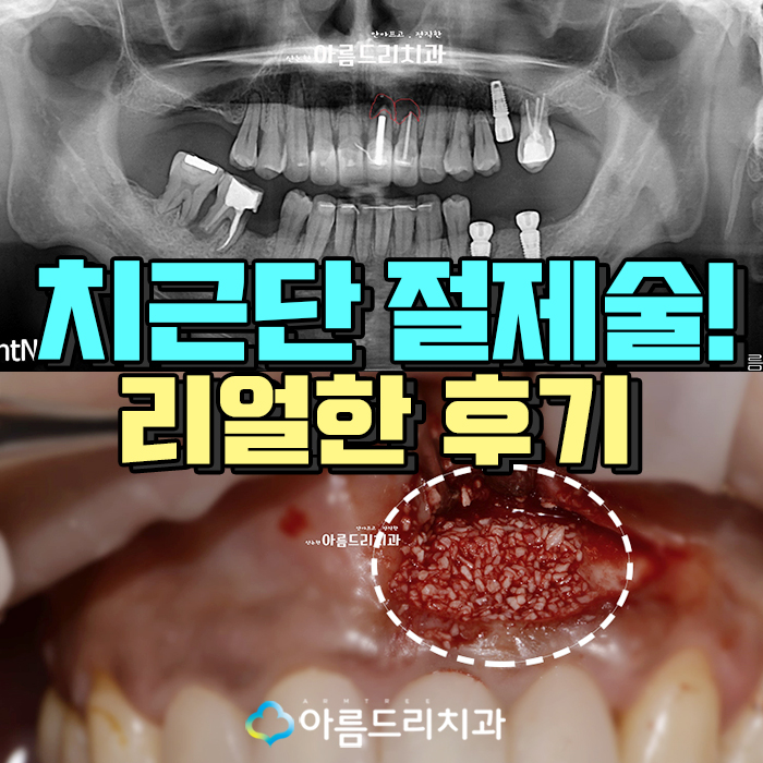 치근단절제술 수술후기 자연치아 살리기 관련 이미지 1
