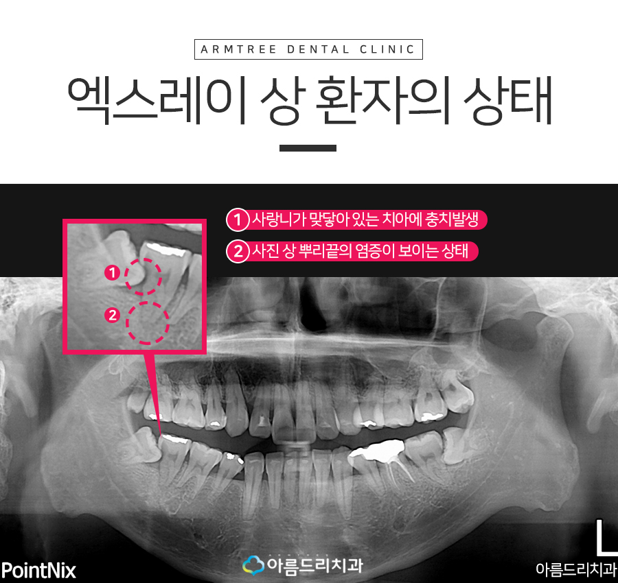 치아재식술 후기 자연치아지키기 관련 이미지 4