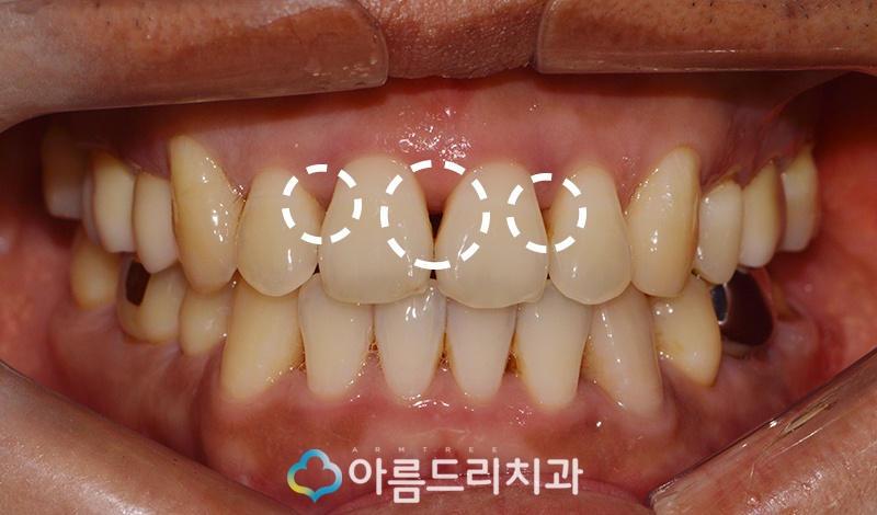 앞니블랙트라이앵글 치료 치아 후기 관련 이미지 3