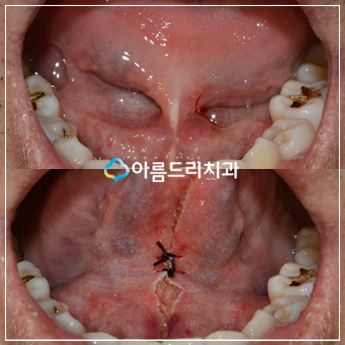 성인설소대수술 단축증치료 아름드리치과 관련 이미지 1