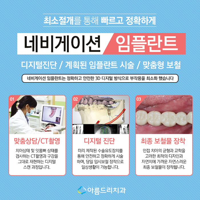 디지털인플란트 치아인플란트 정확도 차이 관련 이미지 4