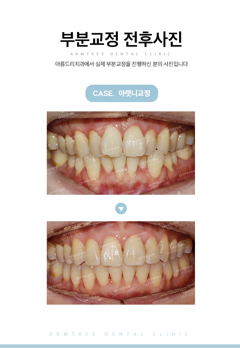 아랫니부분교정후기 현명하게 신논현역 아름드리치과 관련 이미지 10