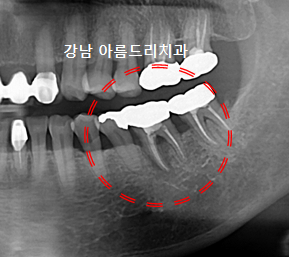 치아 통증은 있는데 이상은 없다?(재식, 임플란트_아름드리 치과) 관련 이미지 8