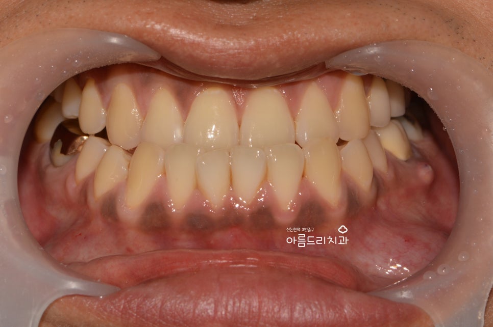 검은 잇몸! 잇몸미백으로 선홍빛 깨끗하게 관련 이미지 3
