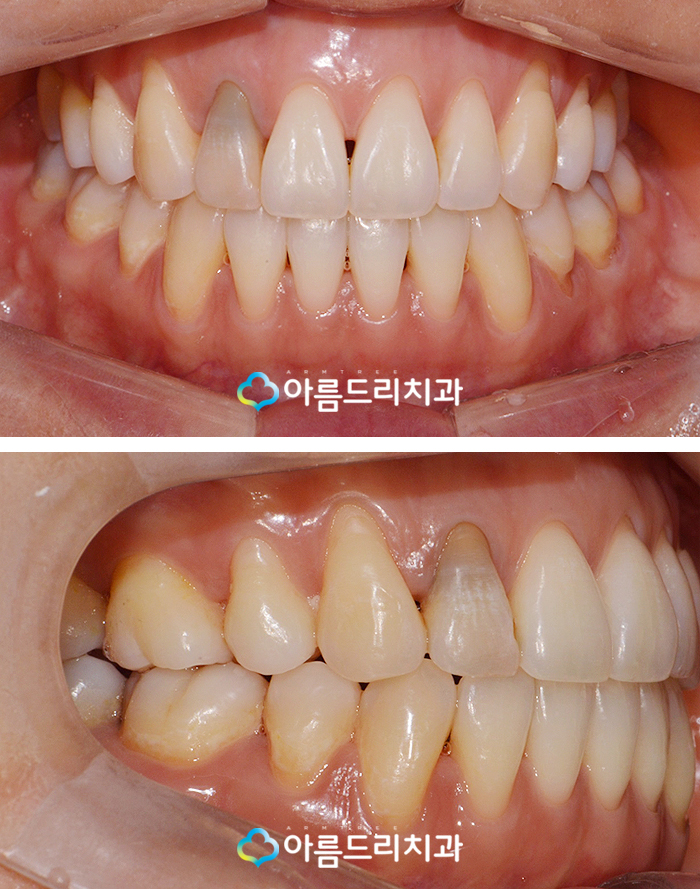 실활치 미백으로 앞니변색 해결후기 관련 이미지 5