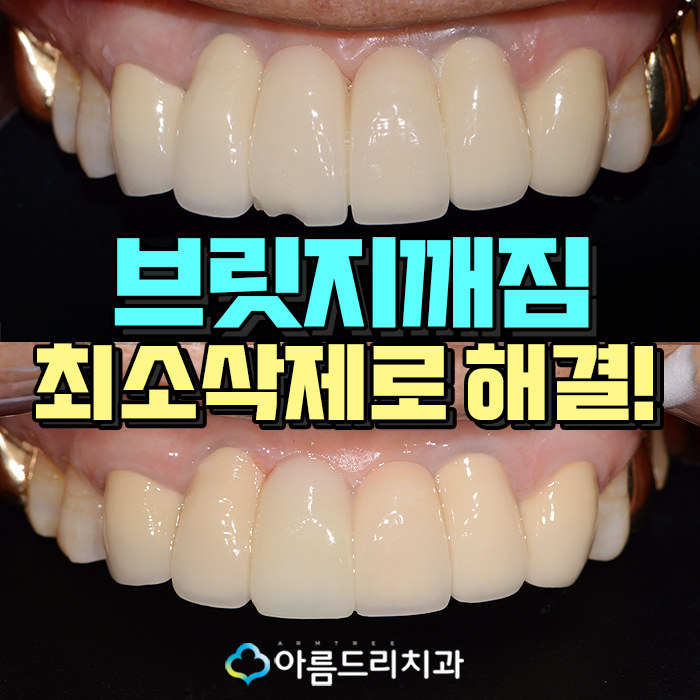 앞니 브릿지가 깨졌어요 치과치료 관련 이미지 1
