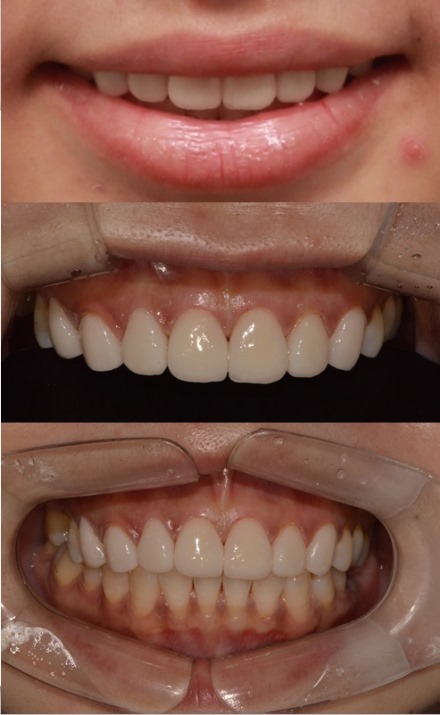 앞니 충치,앞니변색은 라미네이트로 해결(라미네이트가격문의) 관련 이미지 3