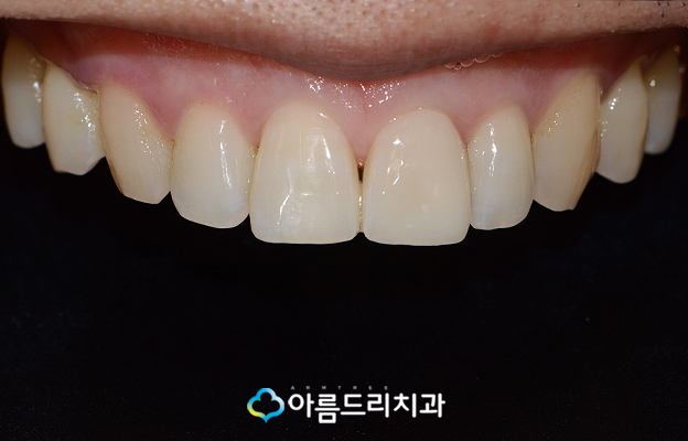 앞니깨짐 치료 최소삭제라미네이트 리얼후기 관련 이미지 8
