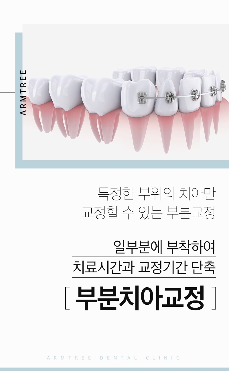 아랫니부분교정 아랫니만 가능한 아름드리치과 관련 이미지 2