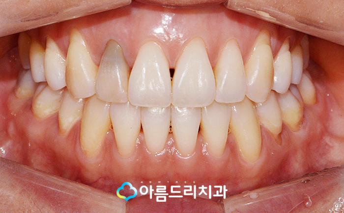 실활치미백 - 앞니변색을 해결하는 치료 관련 이미지 6