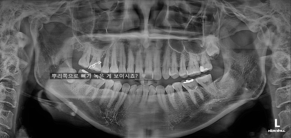무절개 무봉합 상악동 거상술 관련 이미지 1