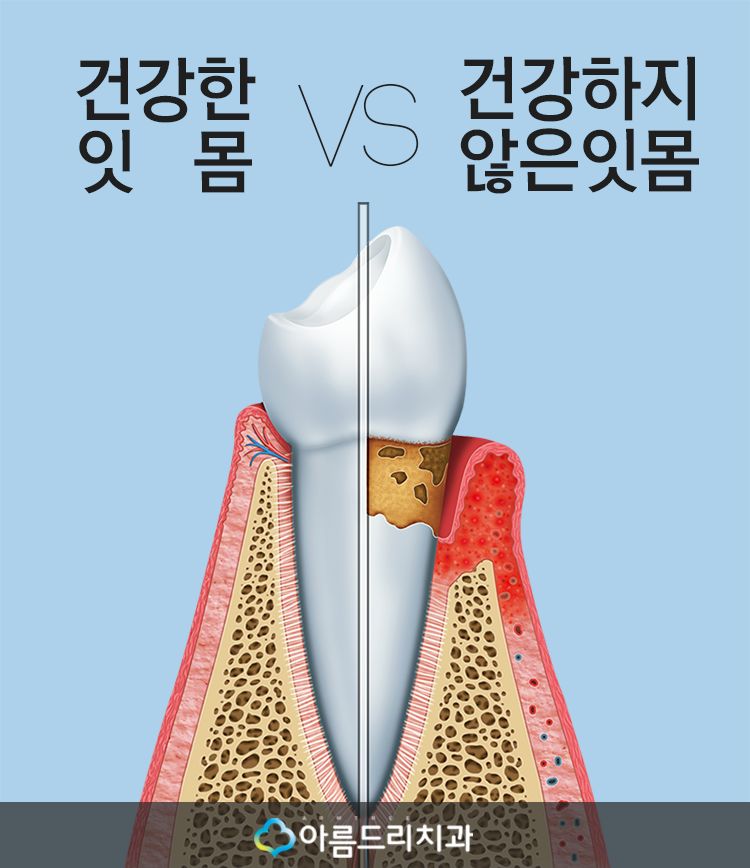 인사돌 이가탄 효과와 잇몸약, 치과에서 바라보다! 관련 이미지 11