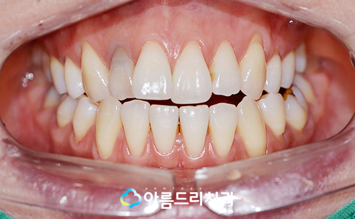 실활치미백 - 앞니변색을 해결하는 치료 관련 이미지 3