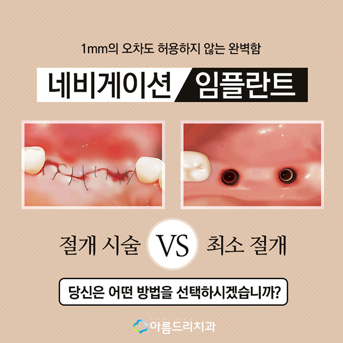 치아인플란트 네비게이션인플란트의 안전함 관련 이미지 3