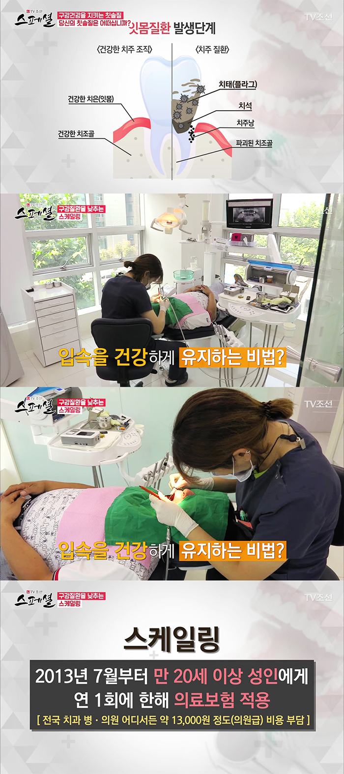 TV조선 스페셜 50회 구강건강관리 관련 이미지 11