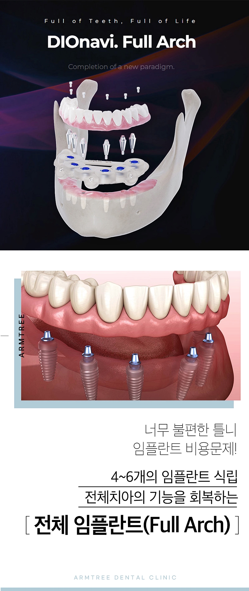 전체임플란트 풀아치임플란트는 아름드리치과라면 관련 이미지 1