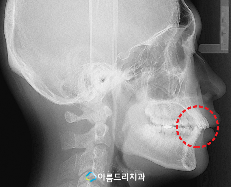부분 설측교정비용 후기가 좋은 치과 관련 이미지 3