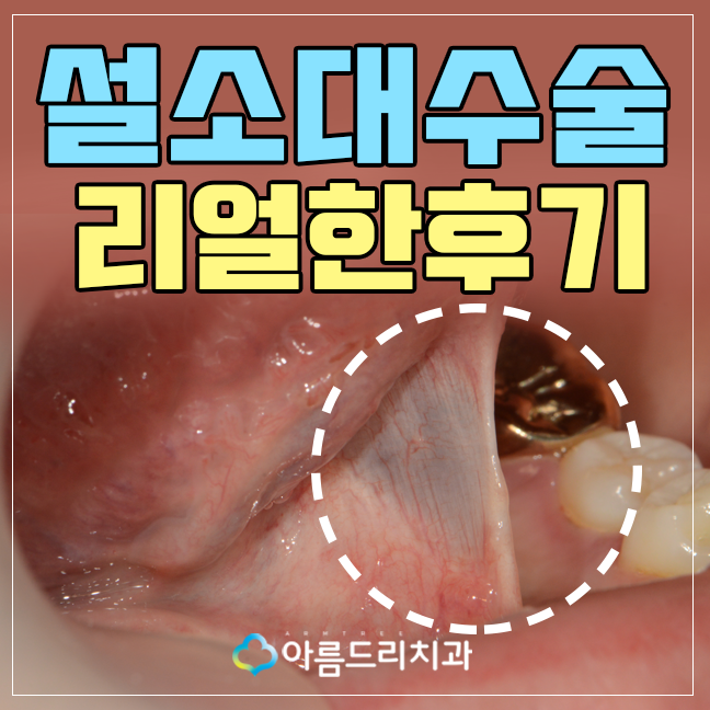 설소대수술 - 실제후기로 보는 확연한 차이 관련 이미지 1