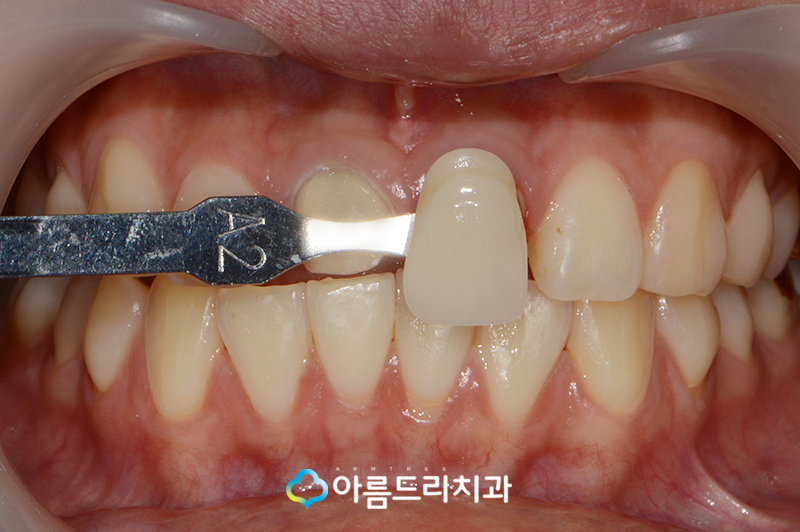 실활치미백 앞니 색깔 신경치료 치아변색 후기 관련 이미지 7
