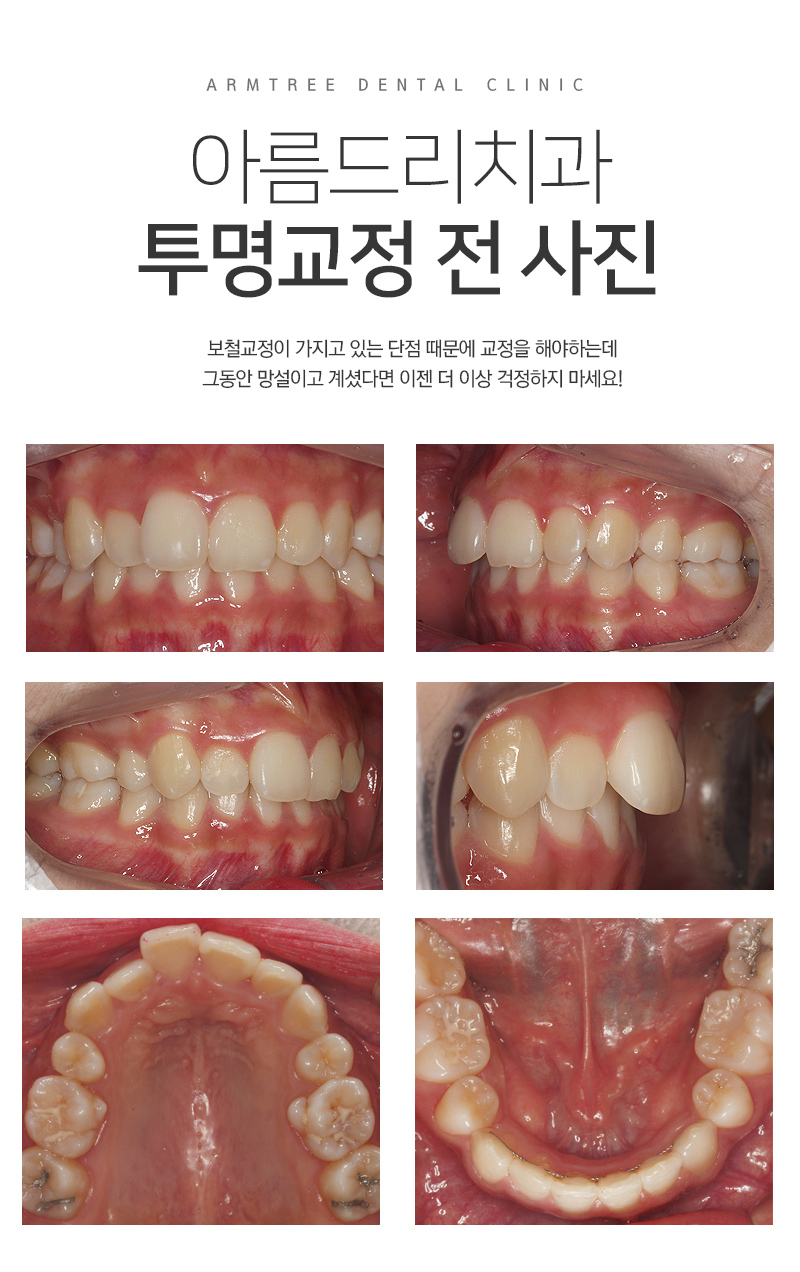 투명교정통증 부작용은 과연? 관련 이미지 5