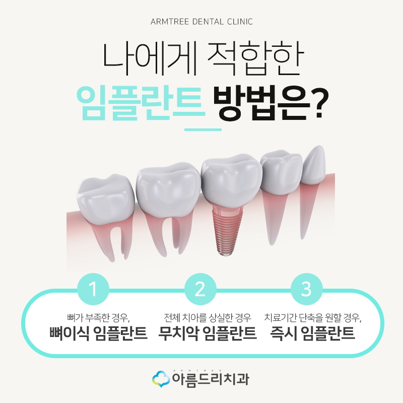 네비게이션 인플란트 기간은 어떻게? 관련 이미지 3