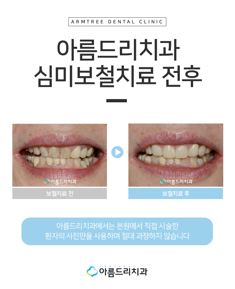 치아보철치료 앞니보철 후기 과연 관련 이미지 8