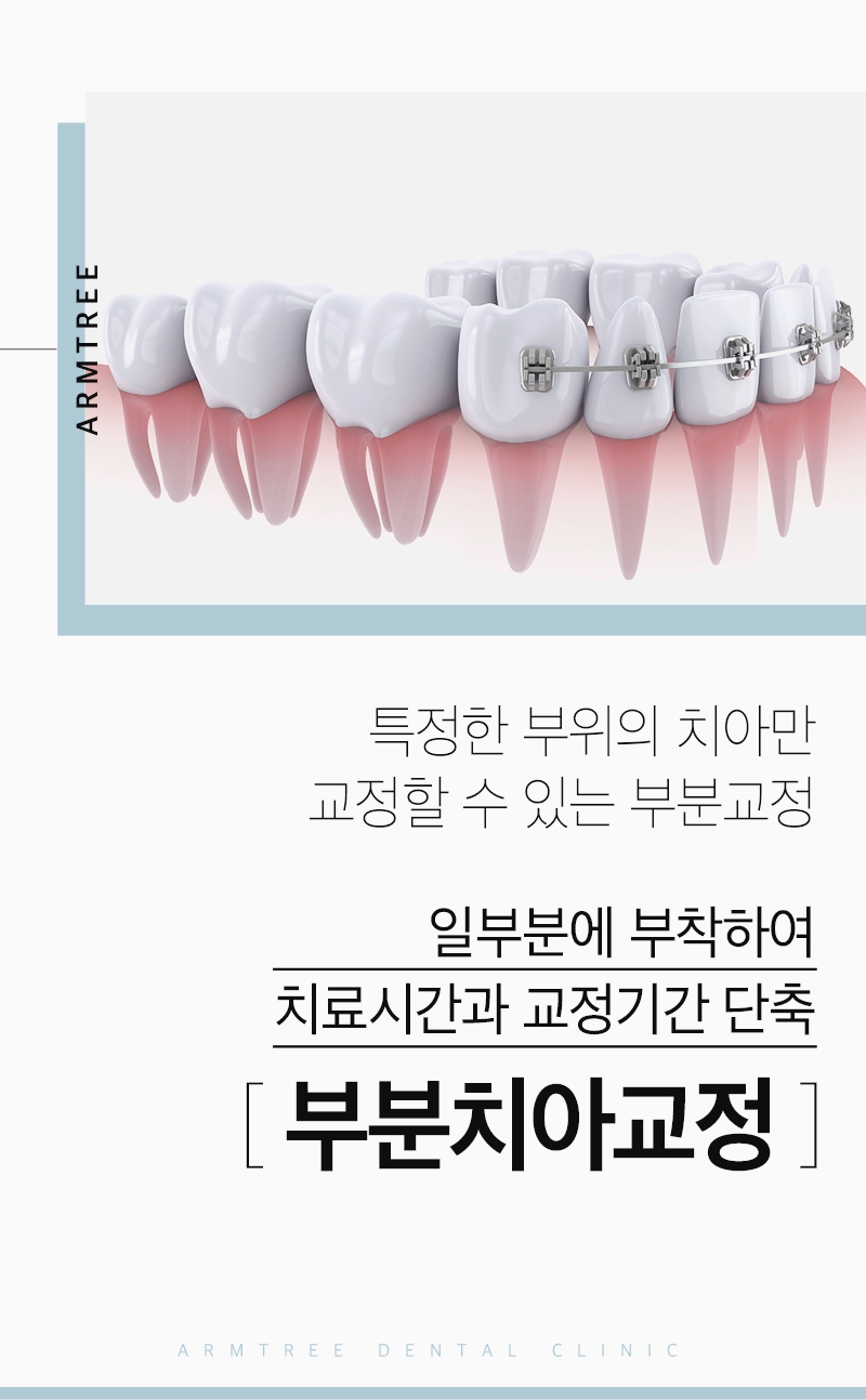 덧니부분교정 아름드리치과에서 확실하게 관련 이미지 2