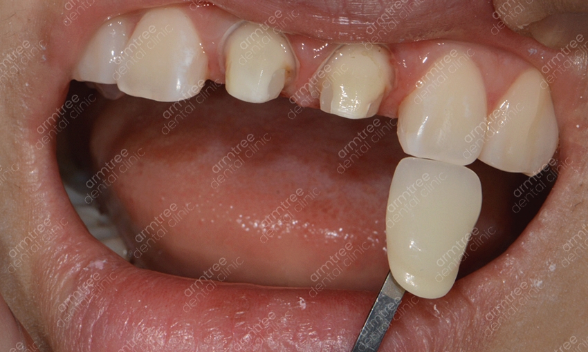 실활치미백 앞니변색 걱정없는 아름드리치과 관련 이미지 9