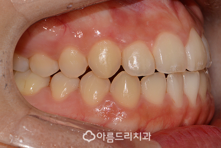 앞니부분교정기간 후기의 변화 관련 이미지 7