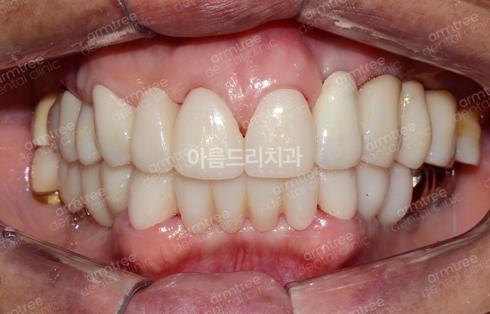 임플란트 심미보철 전후 아름드리치과 진료일기 관련 이미지 8