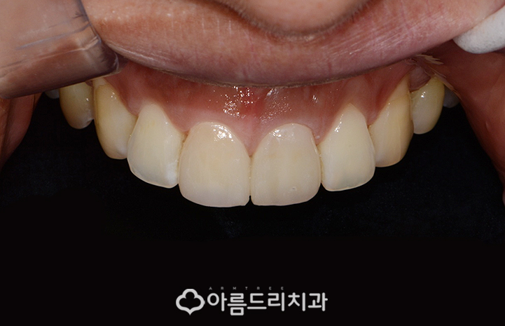 실활치미백 치은 잇몸퇴축 재생으로 동안치아 관련 이미지 8