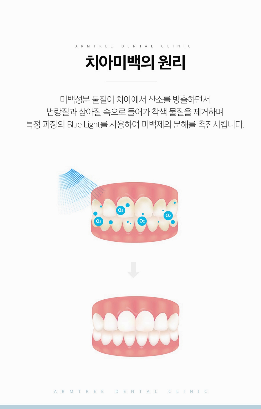 치과치아미백 확실하게 신논현역 아름드리치과 관련 이미지 6