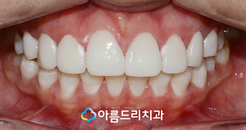 벌어진앞니 앞니라미네이트 치료후기 관련 이미지 8