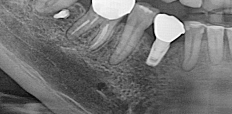 신논현역임플란트 아름드리치과에서 상악동거상술이 필요하면 관련 이미지 14