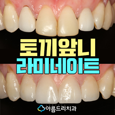 토끼이빨라미네이트 입툭튀 정답은 관련 이미지 1