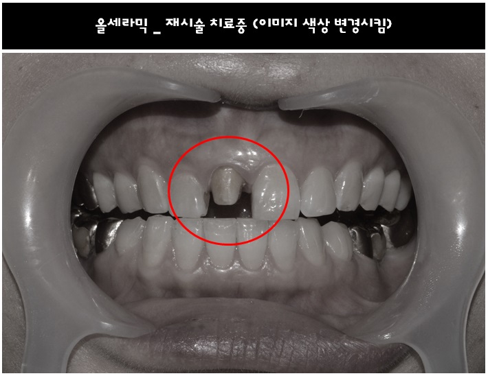 앞니 올세라믹 _재시술 (잇몸변색,메탈노출) 관련 이미지 6