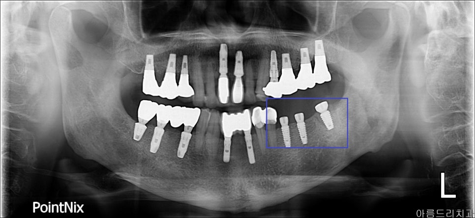 신논현역치과 PRF 자가혈 임플란트. 안전한 임플란트_아름드리 치과 관련 이미지 16