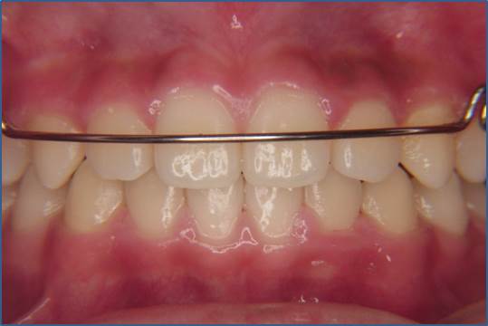 교정 완료_유지 장치 어떤 거 해야 해? 관련 이미지 3