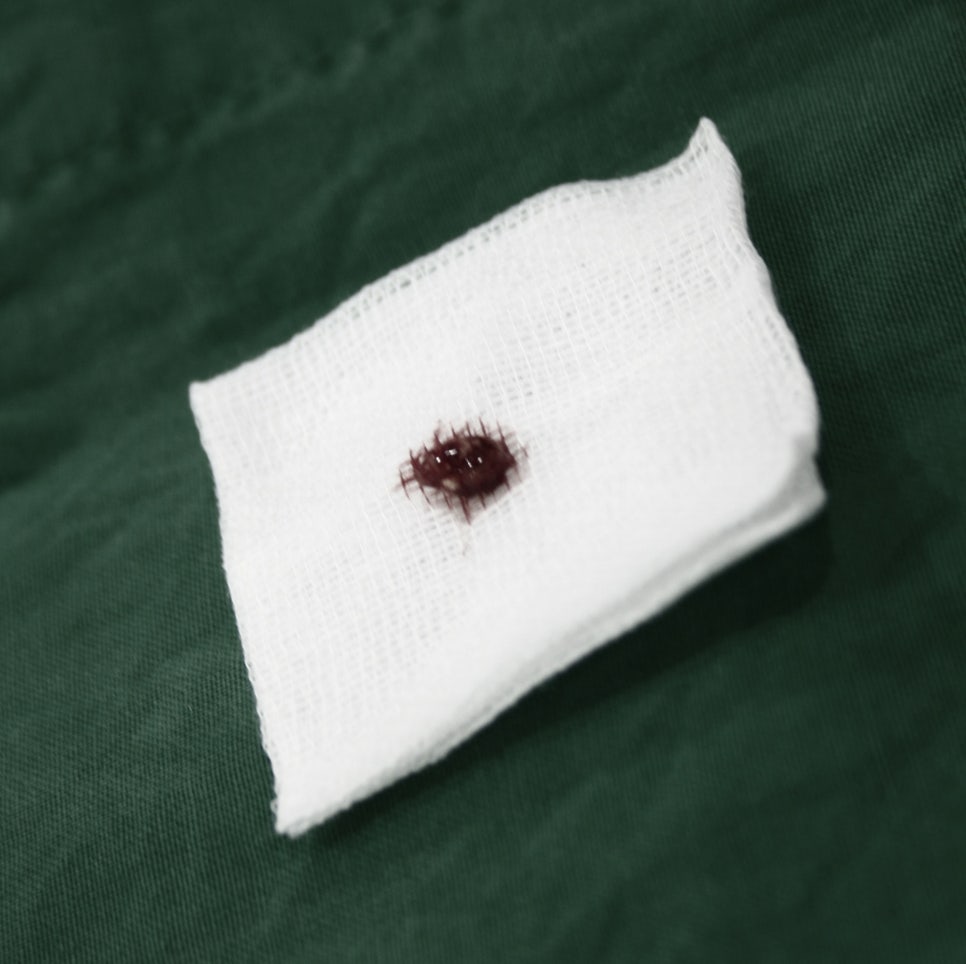 치아재식_임플란트 안 하고 치아 살릴 순 없나요?(신논현역 치과) 관련 이미지 11