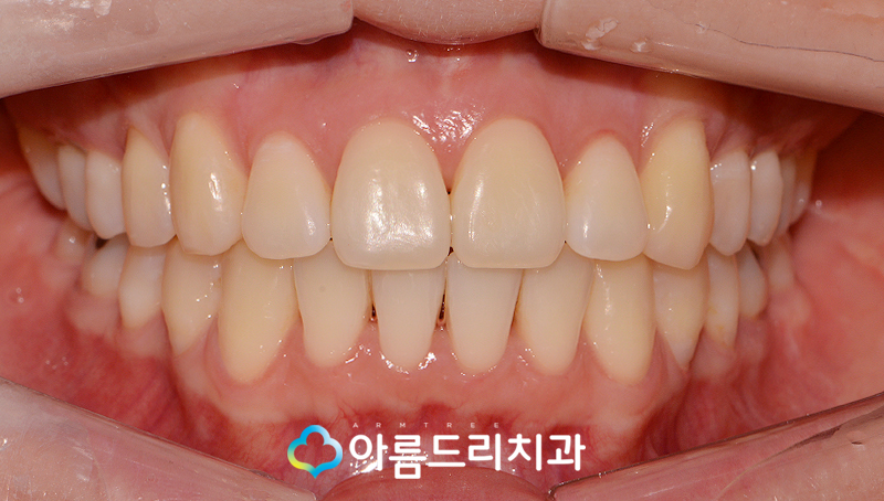 치아부정교합교정 악궁확장장치 후기는? 관련 이미지 9