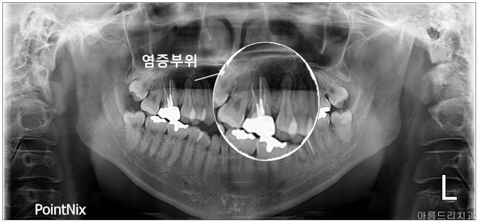 신논현역치과)잇몸고름주머니,잇몸염증,잇몸물집,치아발치 관련 이미지 3